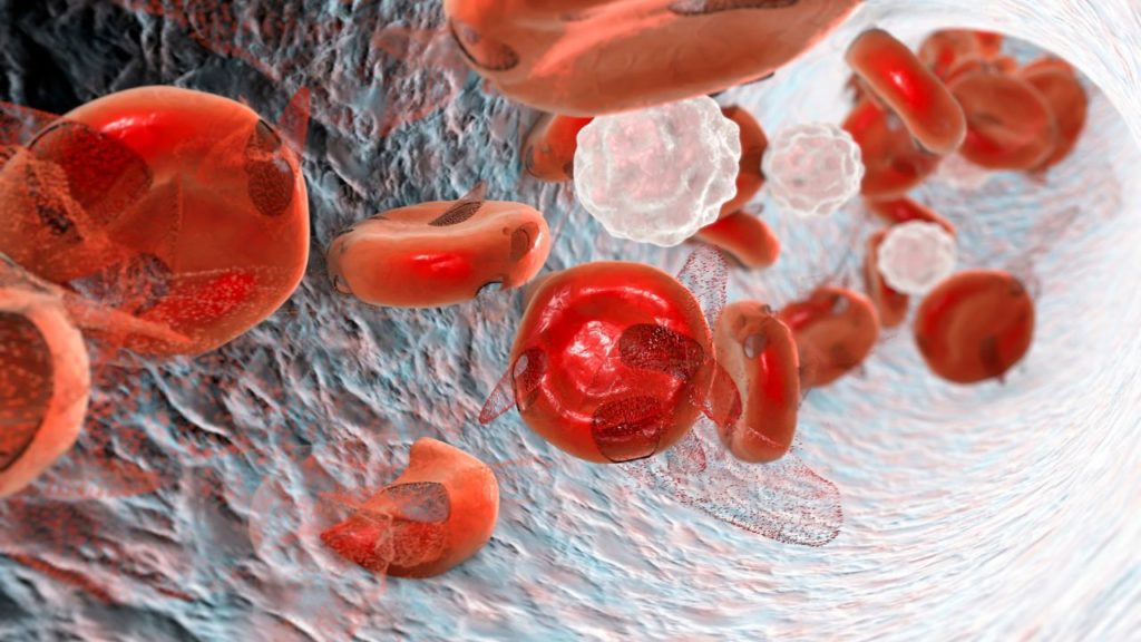 Anemia falciforme – Alterações na coluna e Dor