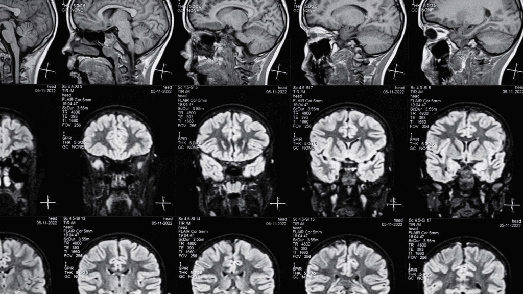 Epilepsia: descubra como essa condição neurológica afeta a vida de milhares de pessoas