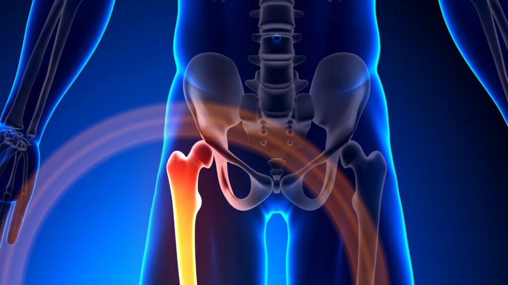 Dor e Rigidez no Quadril? Pode Ser Osteonecrose do Fêmur!