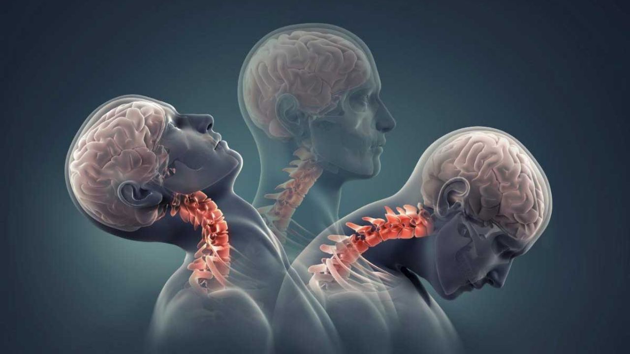 Síndrome da Cabeça Caída: Uma Análise da Condição Neuromuscular Rara