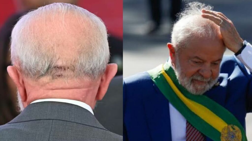 Como evitar ter a doença que o presidente lula teve que operar